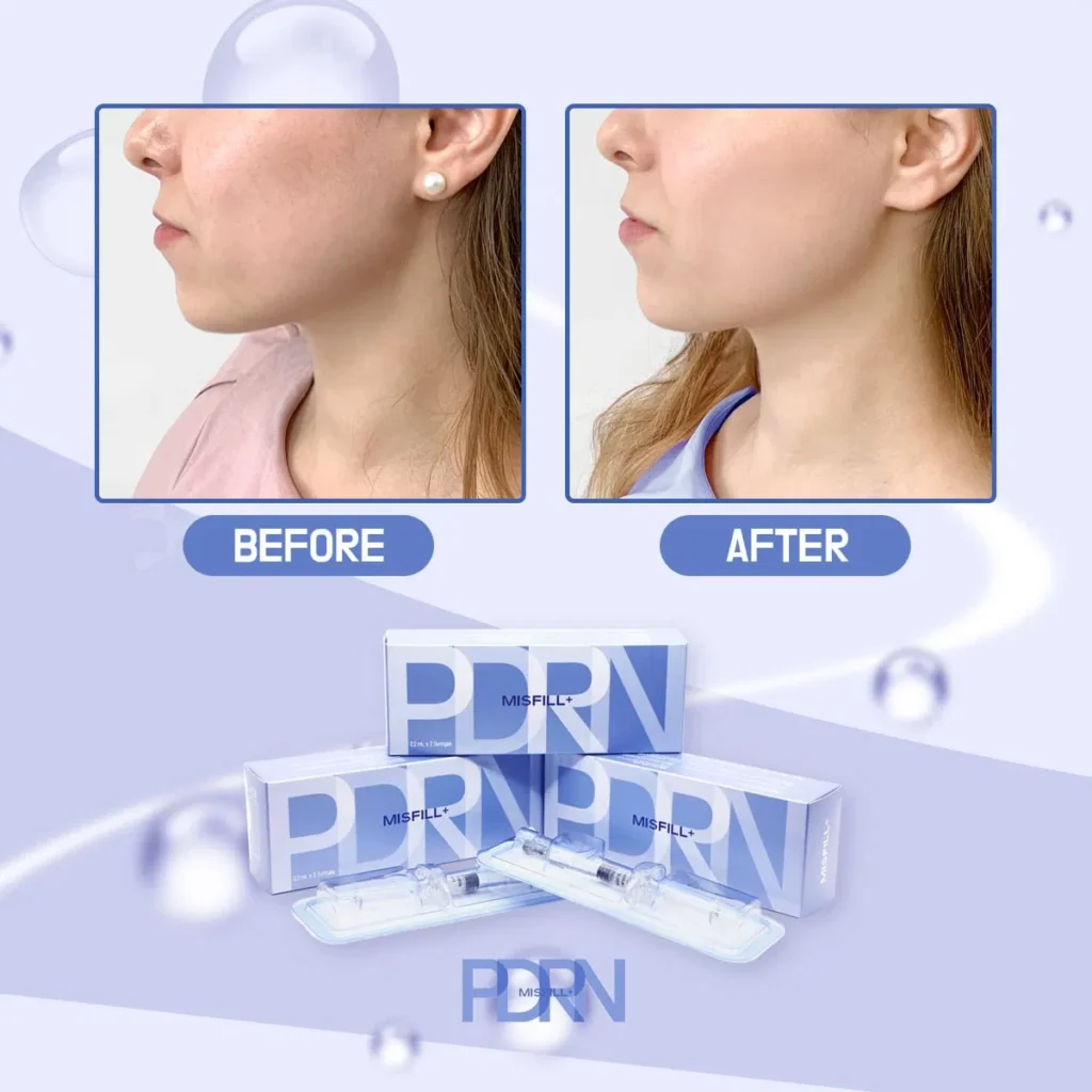 Misfill PDRN Injection